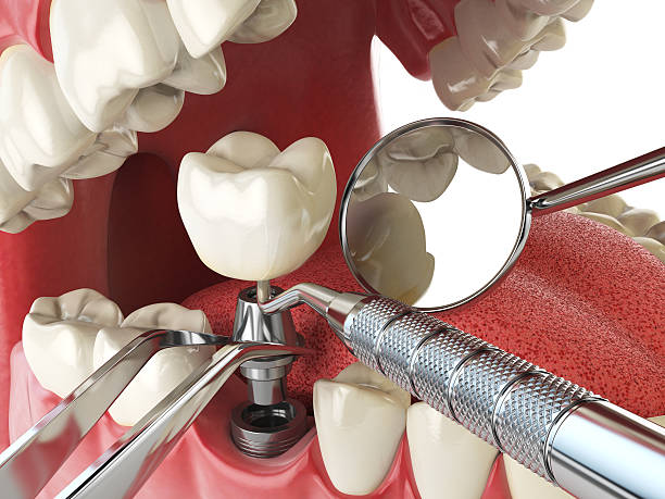 Best Broken or Chipped Tooth Repair in Grants Pass, OR